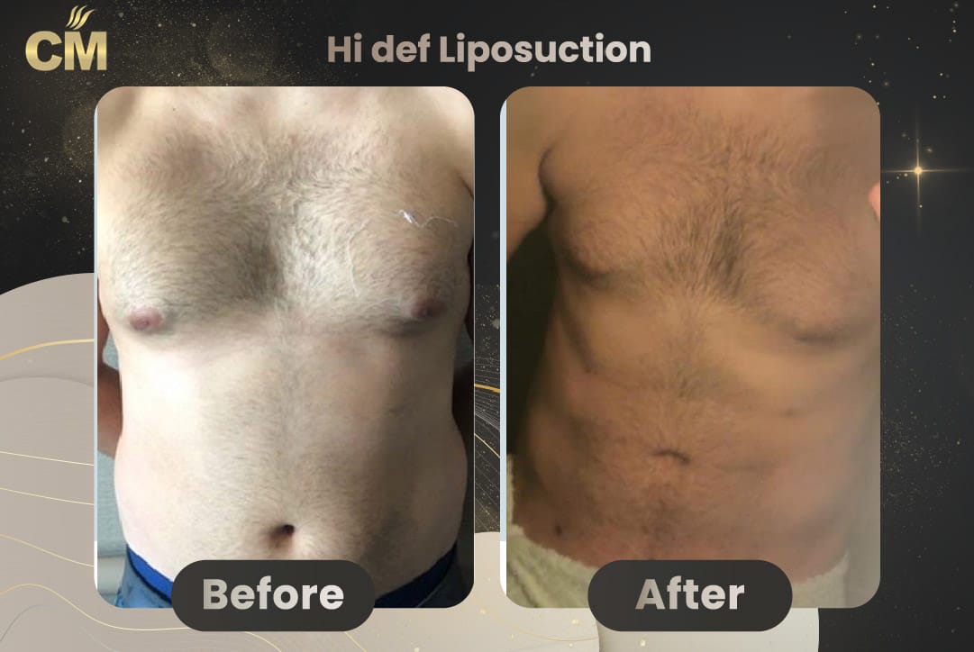 Hi Def Liposuction Before and After in Turkey