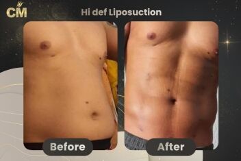 Hi Def Liposuction Before After