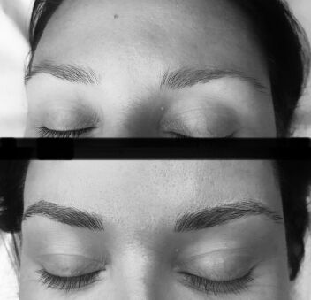 Eyebrow transplant before after1