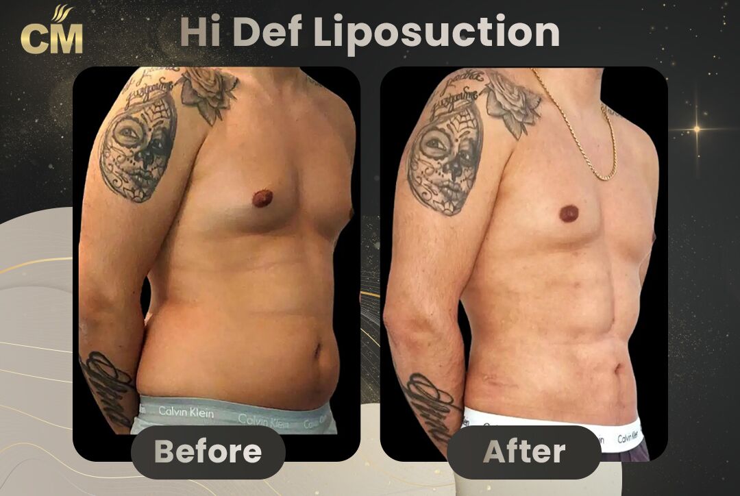 Hi Def Liposuction Before After-2