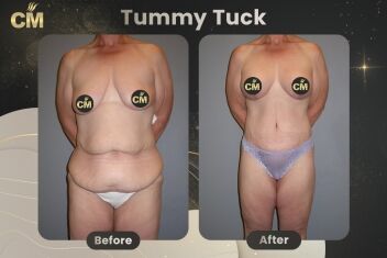 Tummy Tuck Before and After-1