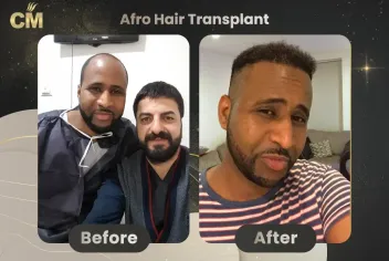 Afro Hair Transplant Before and After