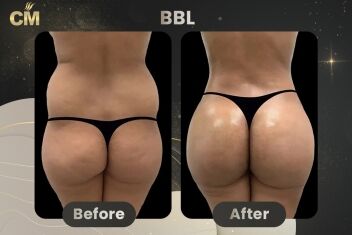 BBL Before and After