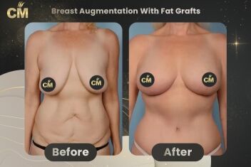 Breast Augmentation With Fat Grafts Before After