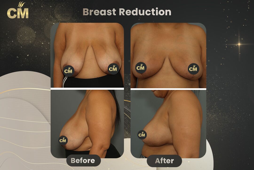 Breast Reduction Before After