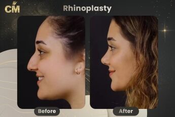 Rhinoplasty Before and After in Turkey