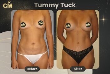 Tummy Tuck Before and After