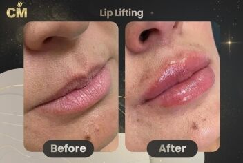 Lip Lift Before After in Turkey