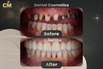 Dental Implants Before and After in Turkey