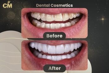 Dental Veneers Before And After in Turkey