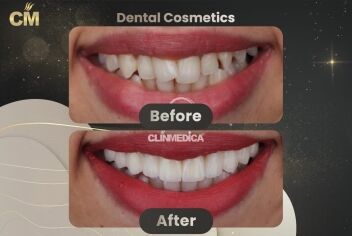 Dental Veneers Before And After in Turkey