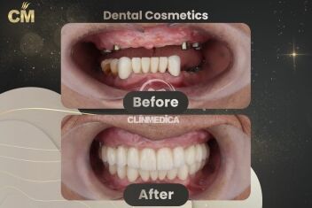 Dental Implants Before and After in Turkey