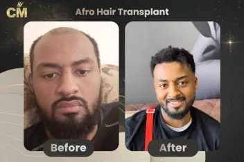 Afro-Haartransplantation Vorher und Nachher-2