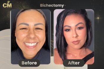 Bichectomy Before and After in Turkey-2