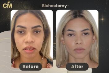 Bichectomy Before and After in Turkey-1
