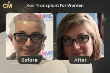Hair Transplant For Women Before and After in Turkey