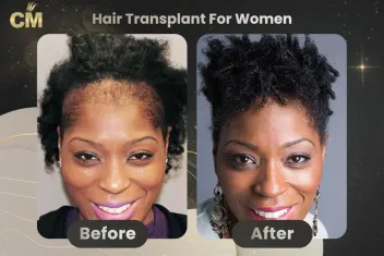 Hair Transplant For Women Before After in Turkey-3