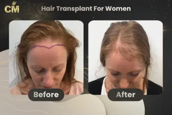 Hair Transplant For Women Before and After in Turkey