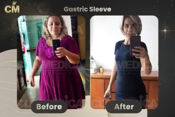 Obesity And Gastric Sleeve Before and After in Turkey