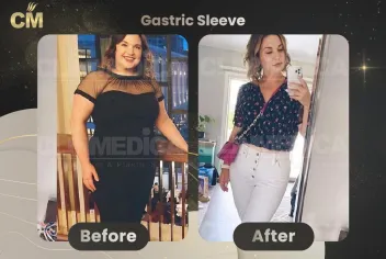Obesity And Gastric Sleeve Before and After in Turkey