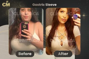Obesity And Gastric Sleeve Before and After in Turkey