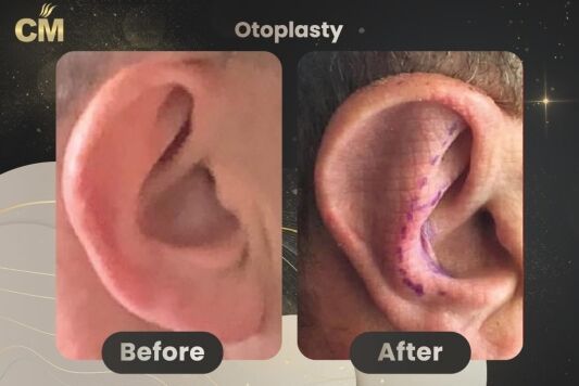 Otoplasty (Ear Surgery) Before After in Turkey-2