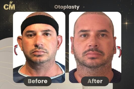 Otoplasty (Ear Surgery) Before After in Turkey 3