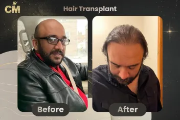 Sapphire Pen Hair Transplant Before and After in Turkey-2