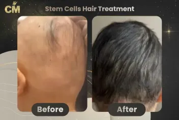 Stem Cells Hair Treatment Before After in Turkey