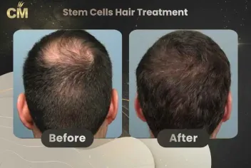 Stem Cells Hair Treatment Before and After in Turkey