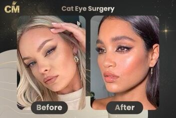 Cat Eye Surgery Before After-1