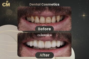Dental Treatment Before and After in Turkey
