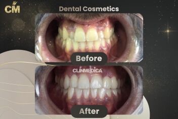 Dental Treatment Before and After in Turkey