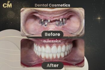 Dental Implants Before and After in Turkey