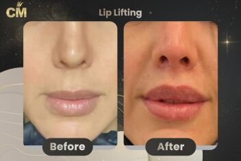 Lip Lift Before After in Turkey-2