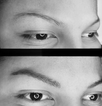 Eyebrow Transplant Before After