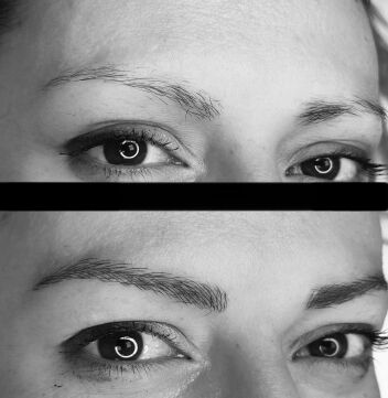 Eyebrow Transplant Before After-2