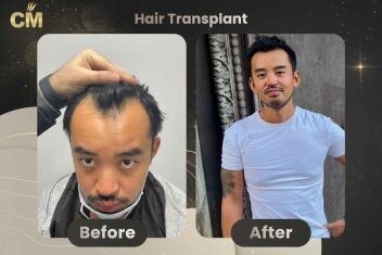 Sapphire fue hair transplant before and after turkey-1