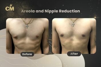 Areola and Nipple Reduction Before After-2