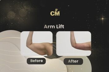 Arm Lift Before After-1