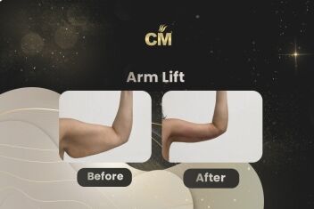 Arm Lift Before After-2