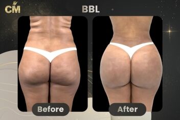 BBL Before and After-1