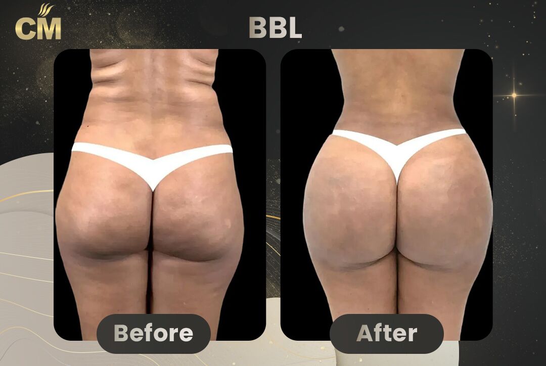 BBL Before and After-1