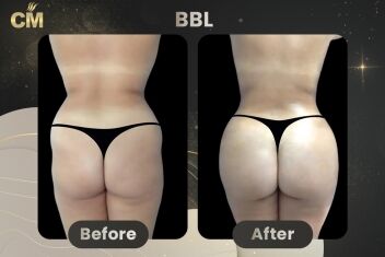BBL Before and After-2
