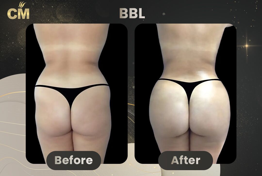 BBL Before and After-2