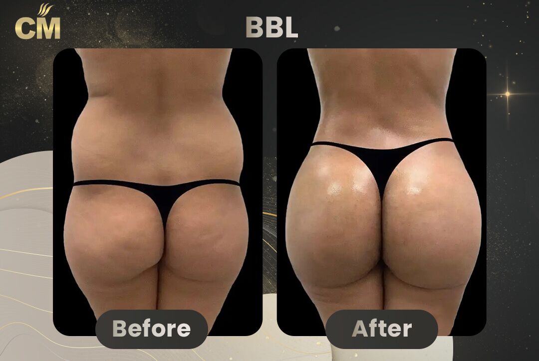 BBL Before and After
