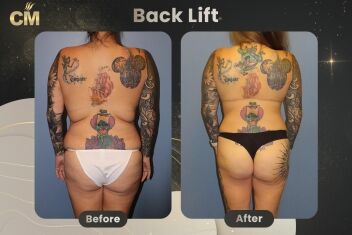 Body Lift Before and After-2
