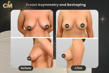 Breast Asymmetry and Reshaping Before After-1