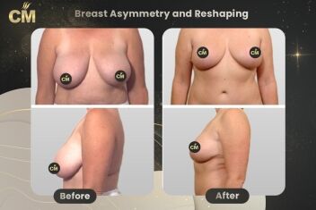 Breast Asymmetry and Reshaping Before After-2
