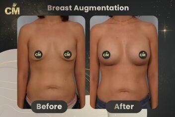 Breast Augmentation Before After-2